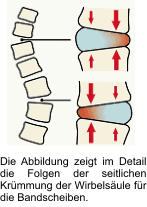 Die Abbildung zeigt im Detail die Folgen der seitlichen Krümmung der Wirbelsäule für die Bandscheiben.